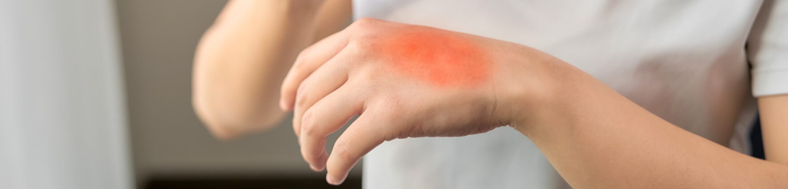 Rötung auf Handrücken – Symbol für entzündliche Hauterkrankung